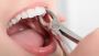Tooth Extraction San Antonio | Painless Wisdom Teeth Removal