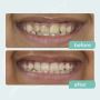 Invisible Braces in Dubai at Mint Dental Care