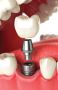 Best dental Implants clinic in Perris | Dentist in Perris | 