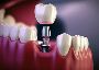 Dental implants in chennai - sendhil dental care