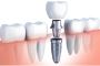 Get Affordable Dental Implants in South Carolina