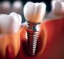 Discover the Cost of Dental Implants in Ahmedabad