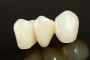 Dental Crowns Services in Pittsburgh, Pennsylvania