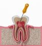 Comprehensive Root Canal Care in Pittsburgh, PA