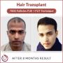 Long Hair Transplant in India - Dr. Amit Gupta