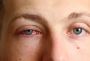 What is Pink Eye? Causes, Symptoms, and Prevention