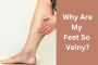 Veiny Feet: Causes, Symptoms, and Treatment Options