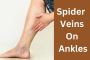 Spider Veins: A Comprehensive Guide To Prevention And Treatm