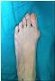 5 Types of foot surgery for bunions