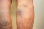 How can I get rid of varicose veins without surgery?