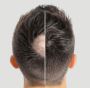 Hair System for Men from Hair Loss Clinic Perth