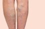 Effective and Safe Treatments for Varicose Veins