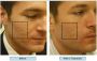 Laser Acne Scar Removal