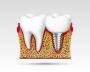 Get Your Smile Back with Dental Crowns in Jasper, AL