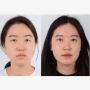 Affordable Eyelid Surgery in Korea: Exceptional Results at M