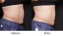 Venus Bliss Max: Solution For Fat Reduction 