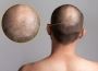 Best Hair Transplant in Chandigarh - Find Your Solution Toda