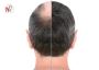 How Much Does A Hair Transplant Cost In Chandigarh, India?