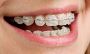 Are you looking for Ceramic Braces Service in Chelsea?