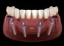 All on 4 dental implants tijuana Mexico