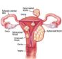 What is a Fibroid Tumor