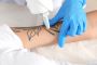 Velvet Tattoo Removal | Tattoo Removal Service in Brooklyn