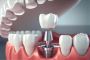Enhance Your Smile with Superior Dental Implants in Hawthorn