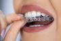 Get Your Invisalign Now and Achieve a Perfect Smile