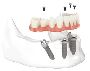 ALL-ON-4 Dental Implants - My Scottsdale Dentist