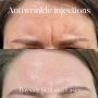 Anti-Wrinkle and Wrinkle Reduction Treatments Melbourne