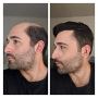 Get the Best Hair Transplant in Massachusetts to change look