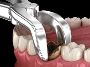 Remove Wisdom Tooth Near You – Quick & Painless