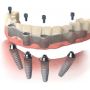 Get Dental Implants at Dr. Helen’s Dental & Implant Studio