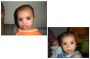 Cleft Lip and Palate Surgery in India | Best Cleft Surgeon