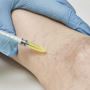 Varicose Veins Treatments in Maryland | AestheticLavc Vein C