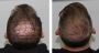 Get Your Confidence Back with Hair Transplant Surgery 