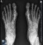 5 Measures of minimally invasive bunion surgery