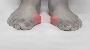 4 Types of foot surgery for bunions: Which is right for you?