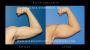 Bicep Implants for Men – Sculpt Your Ideal Arms