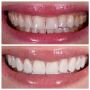 Achieve a Brighter Smile with Porcelain Veneers