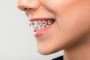 Get Affordable Orthodontics In Fort Worth, Texas