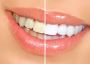 Touch Up Teeth Whitening Treatment in Toronto