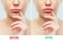 Lip Fillers: Enhance Your Lips with Lifestyle's MedSpa