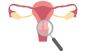 What Is Intramural Leiomyoma of the Uterus?