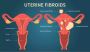 Early Signs: Symptoms of Uterine Fibroids and Cancer