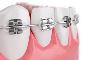 5 Tips For Braces Treatment