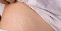 Stretch Mark Treatments at Wymore Laser